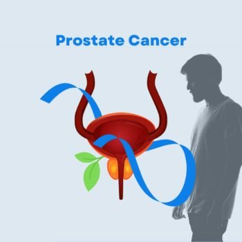 Best Prostate Cancer Treatment Oncologist in Hyderabad