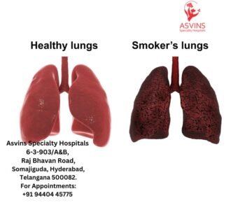 Navigating The Stages Of Lung Cancer: A Comprehensive Guide - Asvins 